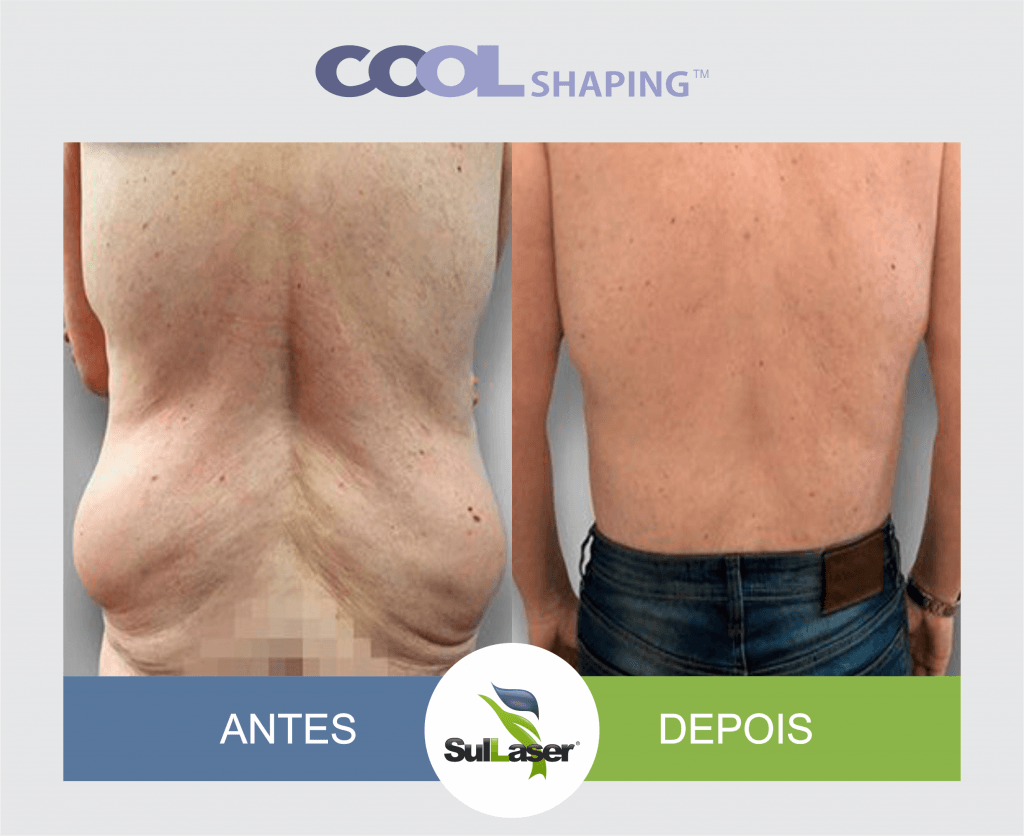 Antes Depois Coolshaping Sullaser Loca Es