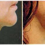 antes-e-depois-delight-1