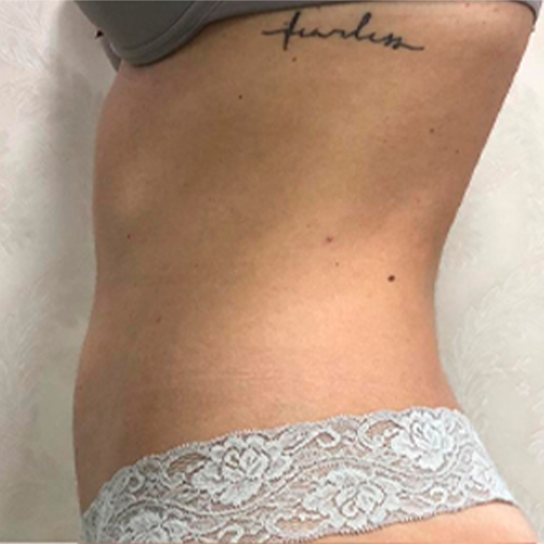 Ultralift Duo Ultralift Duo